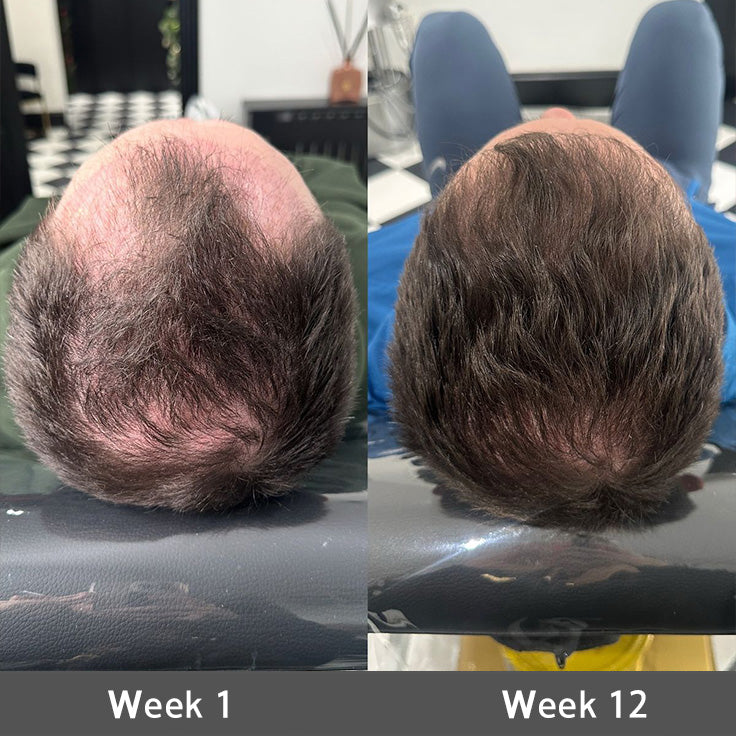 ✅👨‍⚕️ Official Store🔥LOVILDS® Highly Effective Biotin & Rosemary Hair Growth Serum — Visibly fills thinning areas & receding hairlines (🔥 Limited-Time Offer, ⏳ Last 30 Minutes)