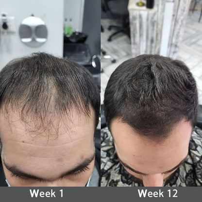 ✅👨‍⚕️ Official Store🔥LOVILDS® Highly Effective Biotin & Rosemary Hair Growth Serum — Visibly fills thinning areas & receding hairlines (🔥 Limited-Time Offer, ⏳ Last 30 Minutes)